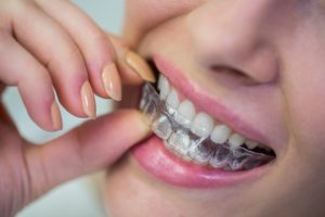 Apparecchio_Invisibile_per_Denti_Come_Funziona_e_Quando_Sceglierlo_b49533a0e3